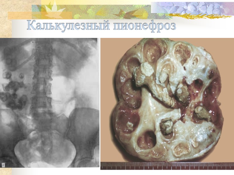 Калькулезный пионефроз